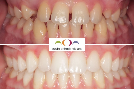 Before and after orthodontic treatment showing teeth alignment improvement with Austin Orthodontic Arts branding.