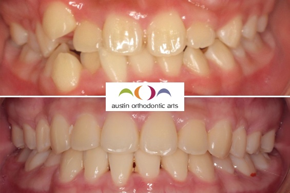 Before and after orthodontic treatment showing corrected dental alignment and bite improvement.