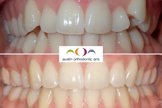 Before and after orthodontic treatment showing improved tooth alignment and bite correction with Austin Orthodontic Arts branding.