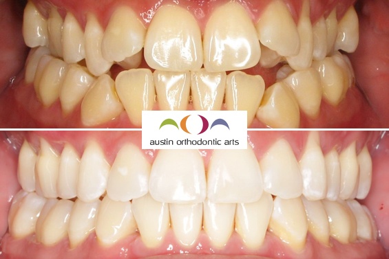 Before and after orthodontic treatment showing improved teeth alignment and bite correction at Austin Orthodontic Arts.