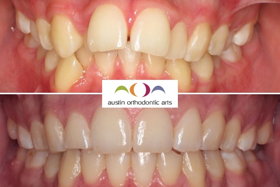 Before and after orthodontic treatment showing corrected tooth alignment and bite improvement.