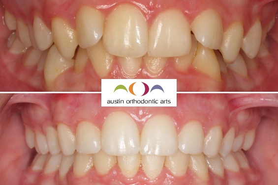 Before and after orthodontic treatment showing improved teeth alignment and bite correction.