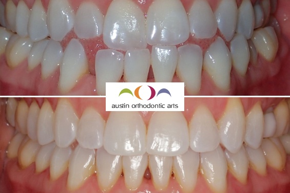 Before and after orthodontic treatment showing improved teeth alignment and bite correction at Austin Orthodontic Arts.