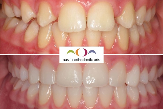 Before and after orthodontic treatment showing teeth alignment correction by Austin Orthodontic Arts.